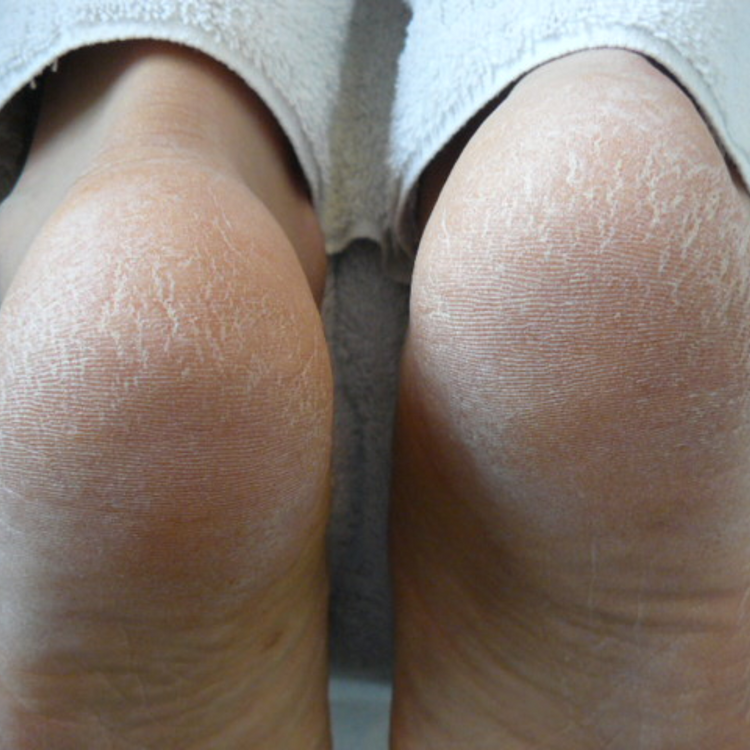 Dry Skin Solutions