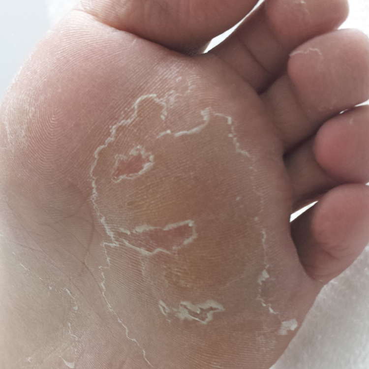 Peeling & Itching Skin