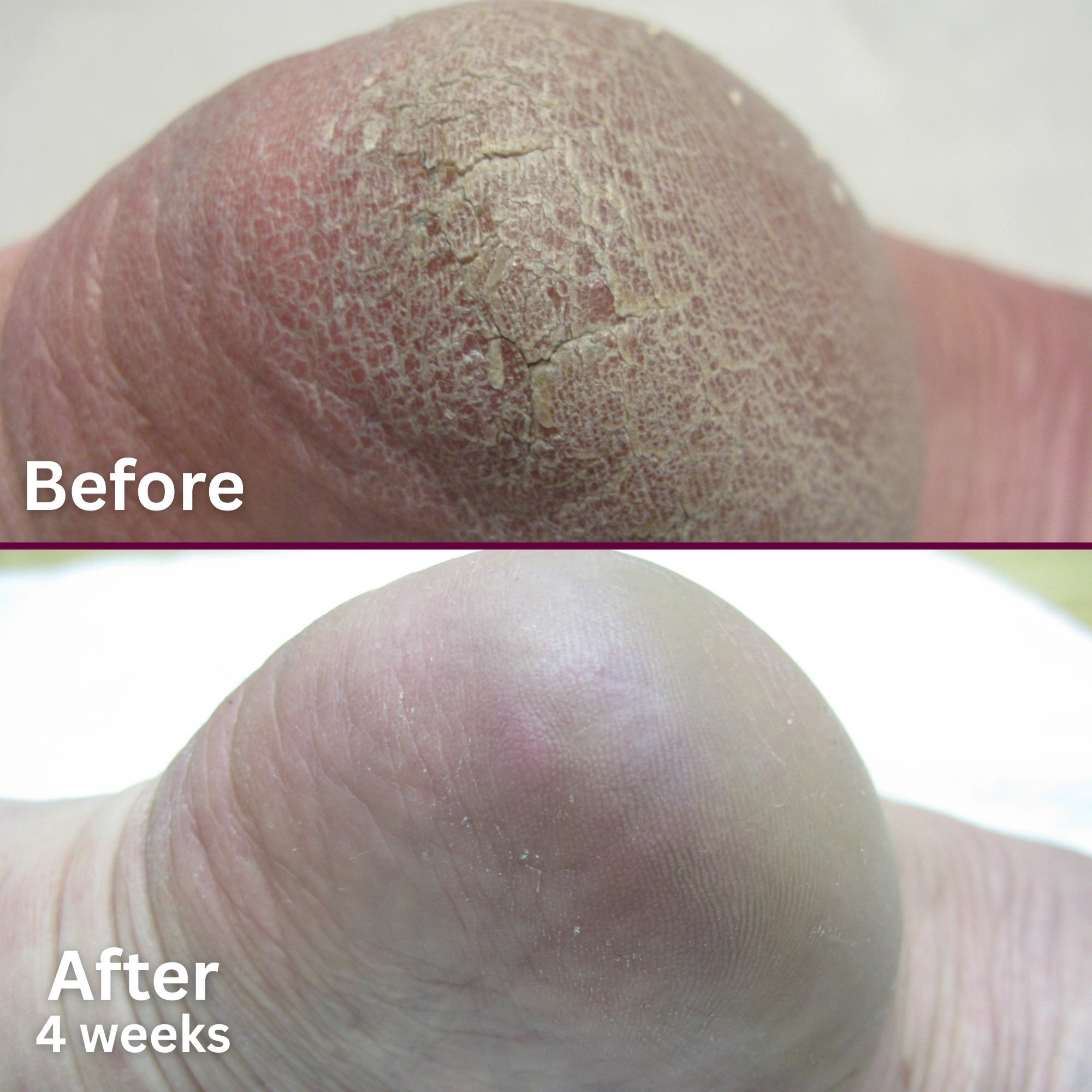 Side-by-side image showing a heel before and after using a rough skin treatment. The top image, labeled 'Before,' displays severely dry, cracked, and thickened skin. The bottom image, labeled 'After 4 weeks,' shows the same heel with dramatically improved skin—smoother, softer, and free from deep cracks.