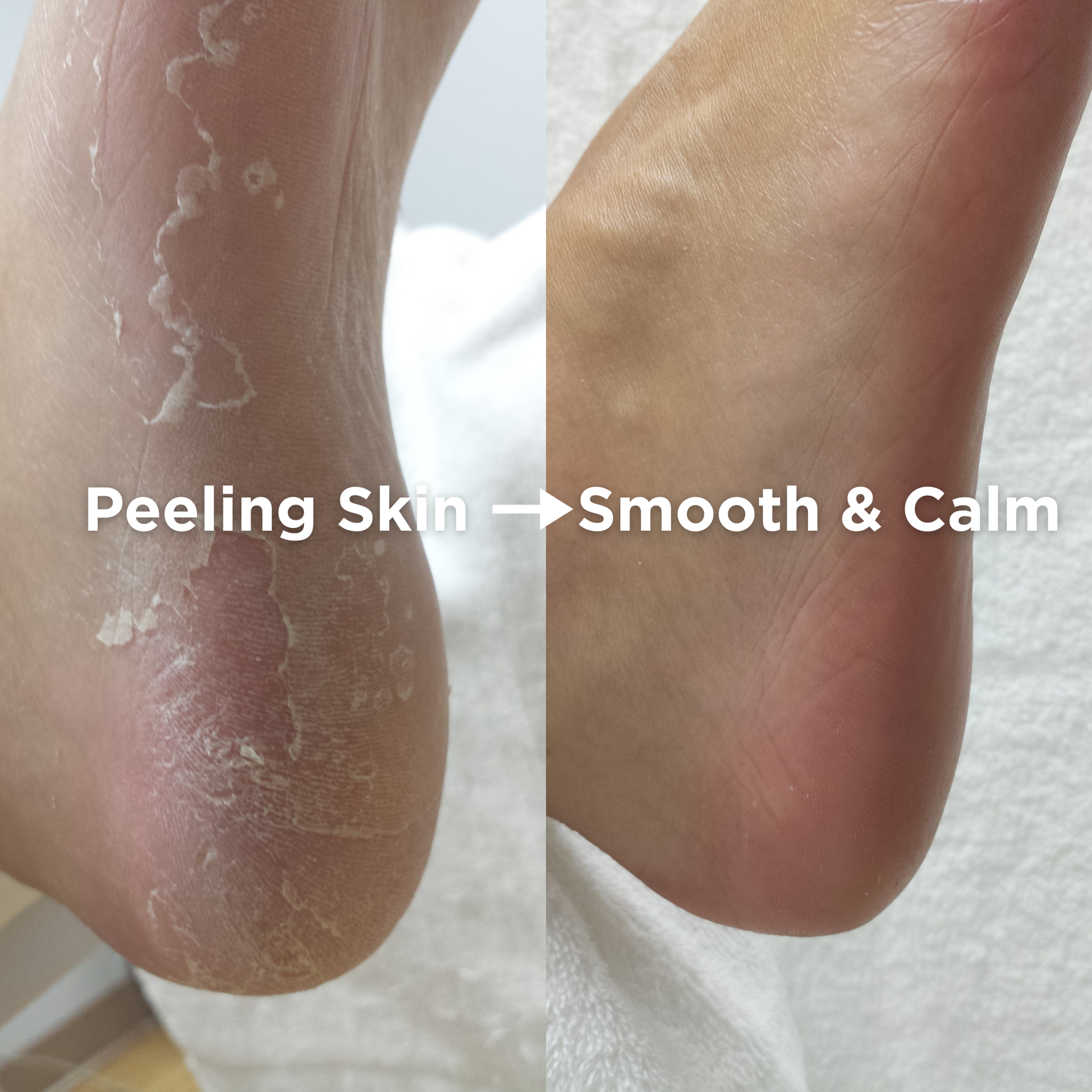 Side-by-side image showing a dry, peeling heel on the left and a smooth, healthy heel on the right, with the text “Peeling Skin → Smooth & Calm.”