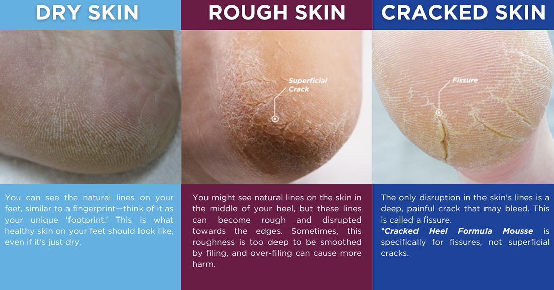 Dry, Rough, or Cracked Skin? Which Footlogix® Formula is Right for You?