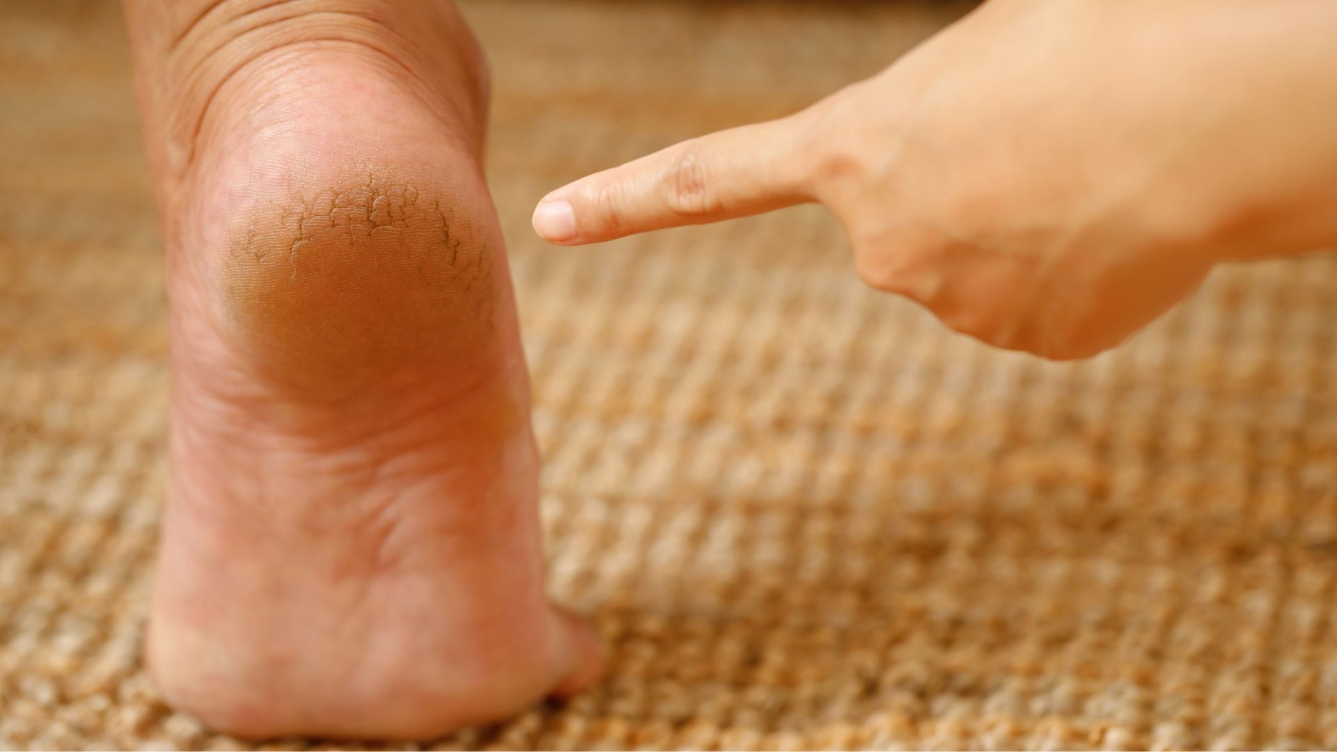 Close-up of cracked heel with a finger pointing at it, highlighting the importance of foot care to prevent discomfort and potential complications from calluses.