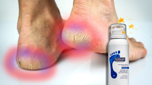 Say Goodbye to Cracked Heels: How Footlogix Cracked Heel Mousse is Transforming Foot Care