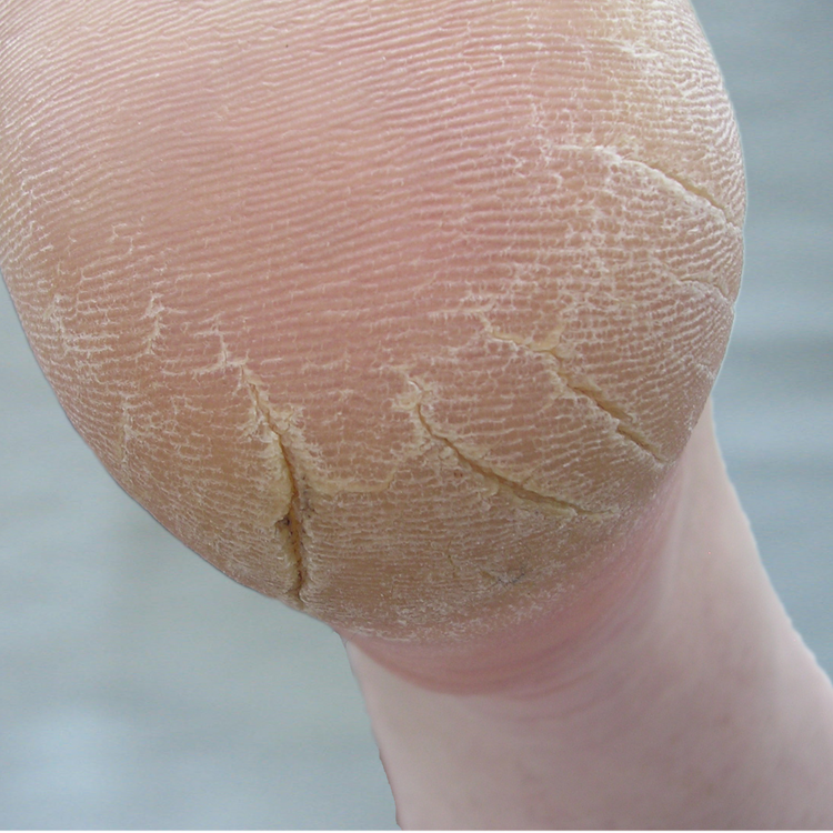 Cracked Heel Solutions