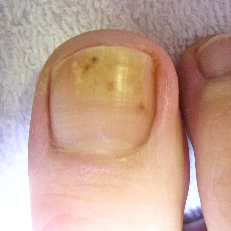 Nail Fungus & Discoloration