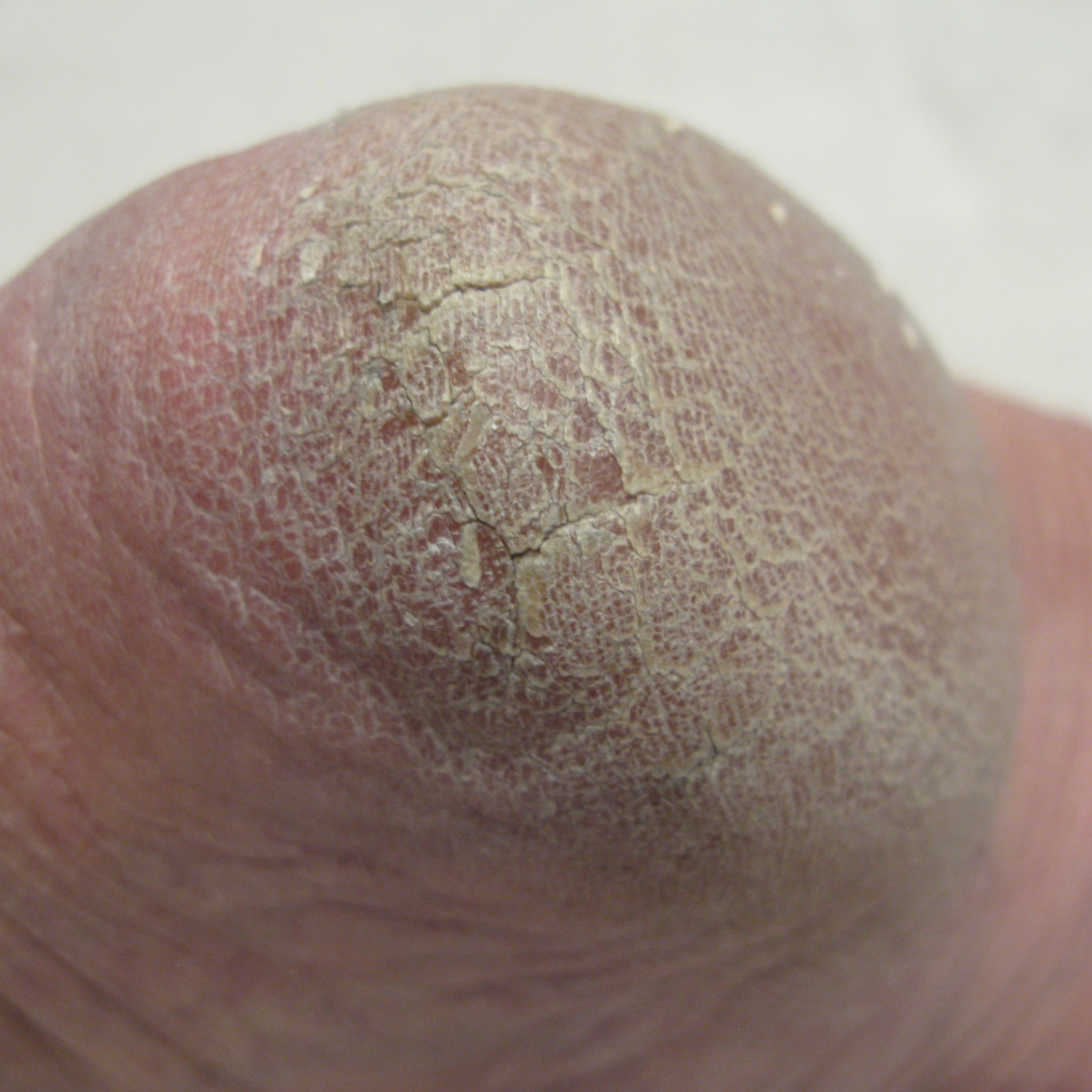 Rough Skin – Footlogix®