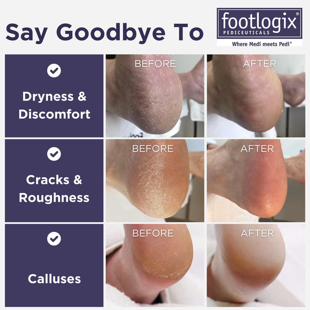 Cracked Heel & Rough Skin Rescue Kit