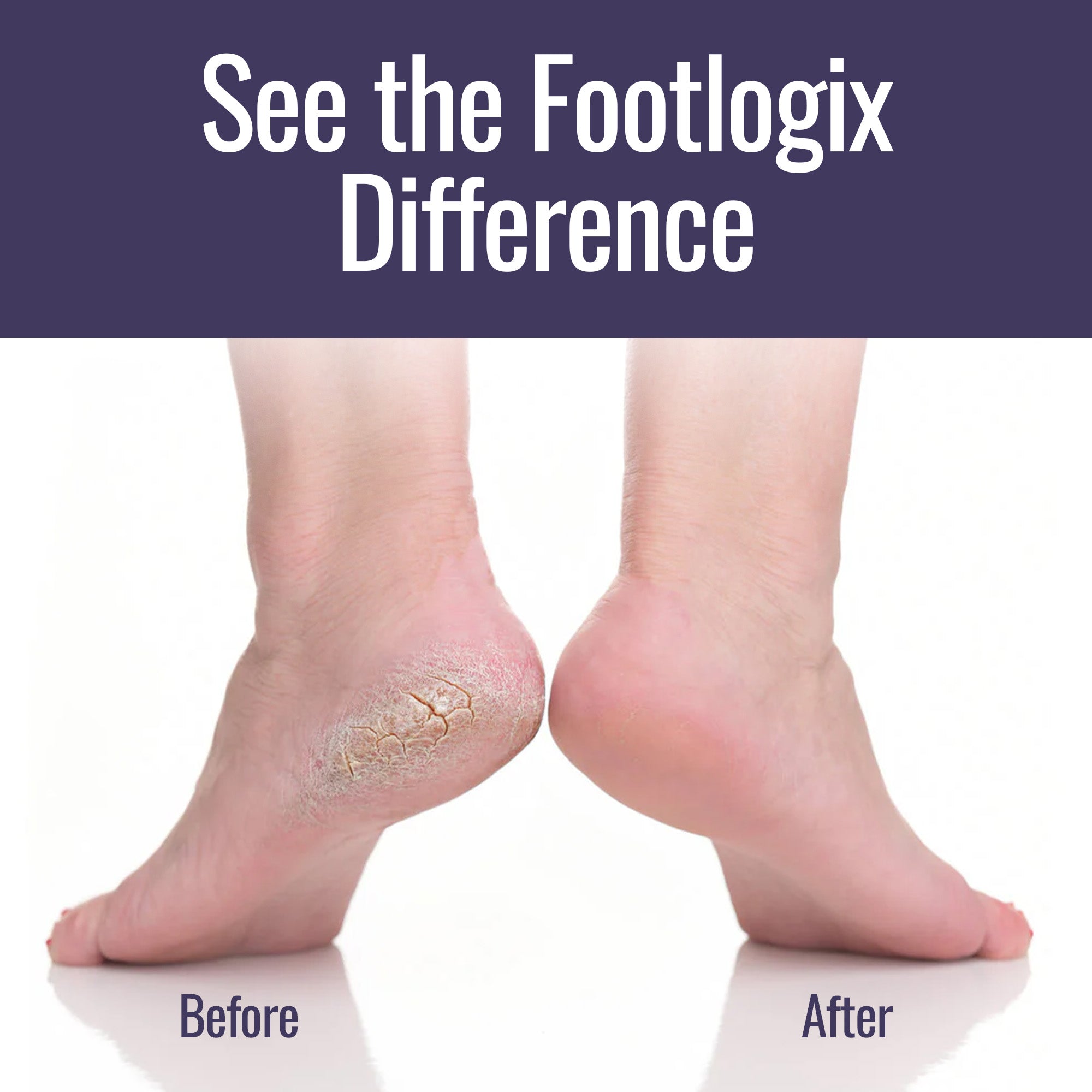 Footlogix before and after photo showing visible improvement in dry, cracked heels with product use.