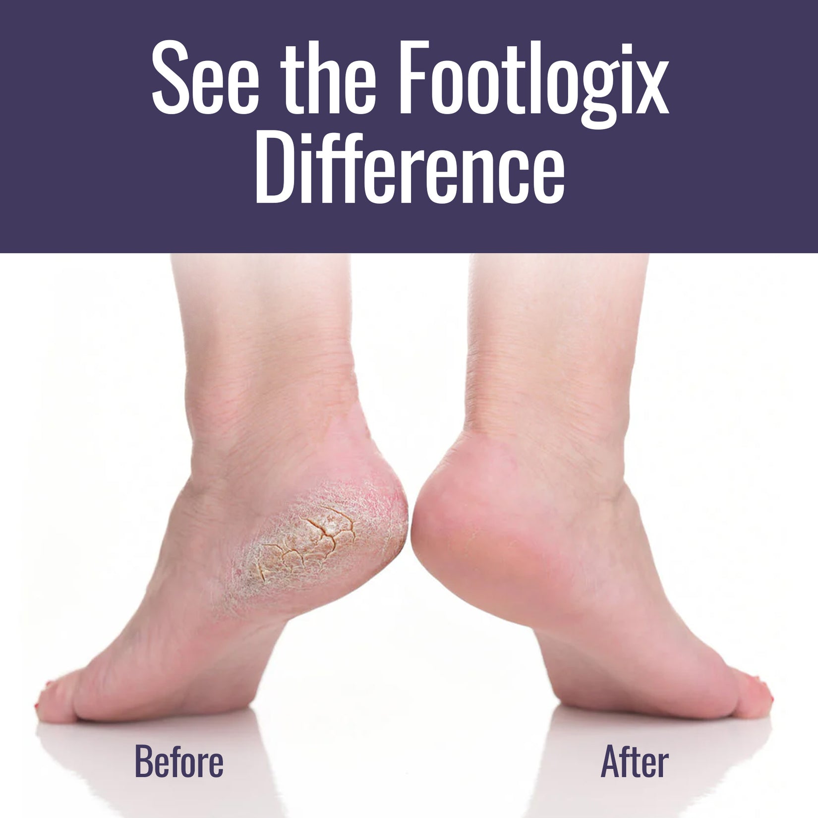 Footlogix® Professional Foot Care | Cracked Heels & Dry Skin Solutions