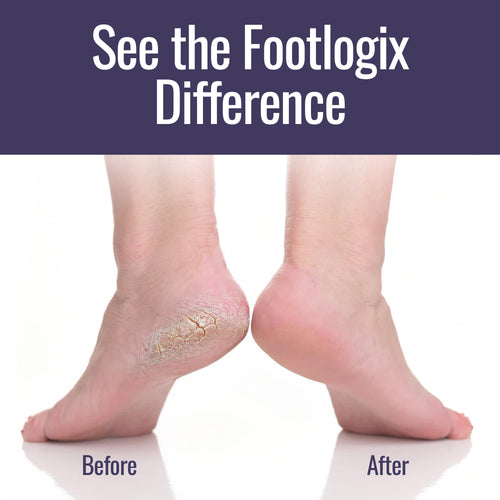Footlogix before and after photo showing visible improvement in dry, cracked heels with product use.