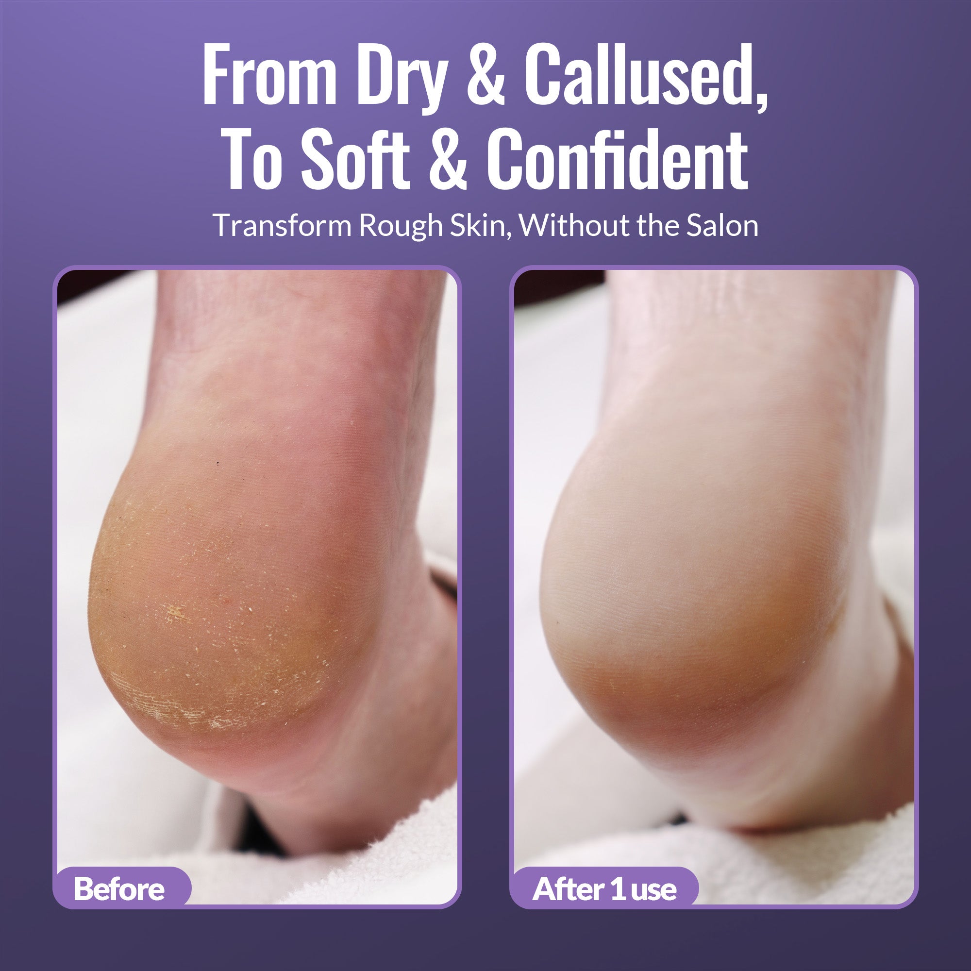Before and after image showing cracked heel transformed to smooth skin after one use of Footlogix Ultimate At Home Combo.