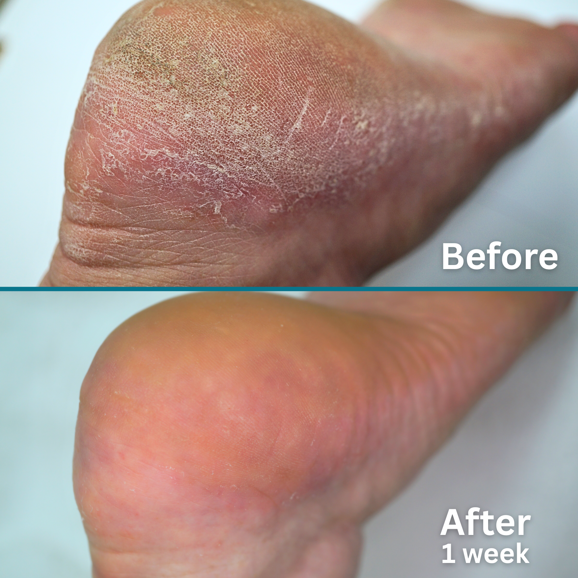 Side-by-side image showing the heel of a foot before and after using a moisturizing foot treatment. The top image, labeled 'Before,' displays dry, rough, and flaky skin. The bottom image, labeled 'After 1 week,' shows the same heel appearing smoother, more hydrated, and visibly healthier with reduced dryness.