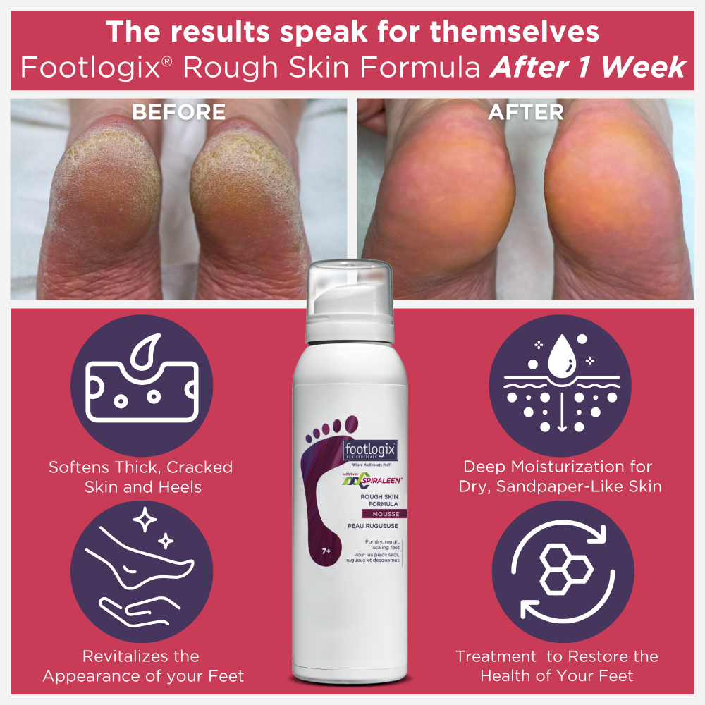 Before and after comparison of feet treated with Footlogix Rough Skin Formula Mousse after 1 week, showing smoother, healthier skin. Highlights include softening thick skin, deep moisturization, and revitalized appearance.