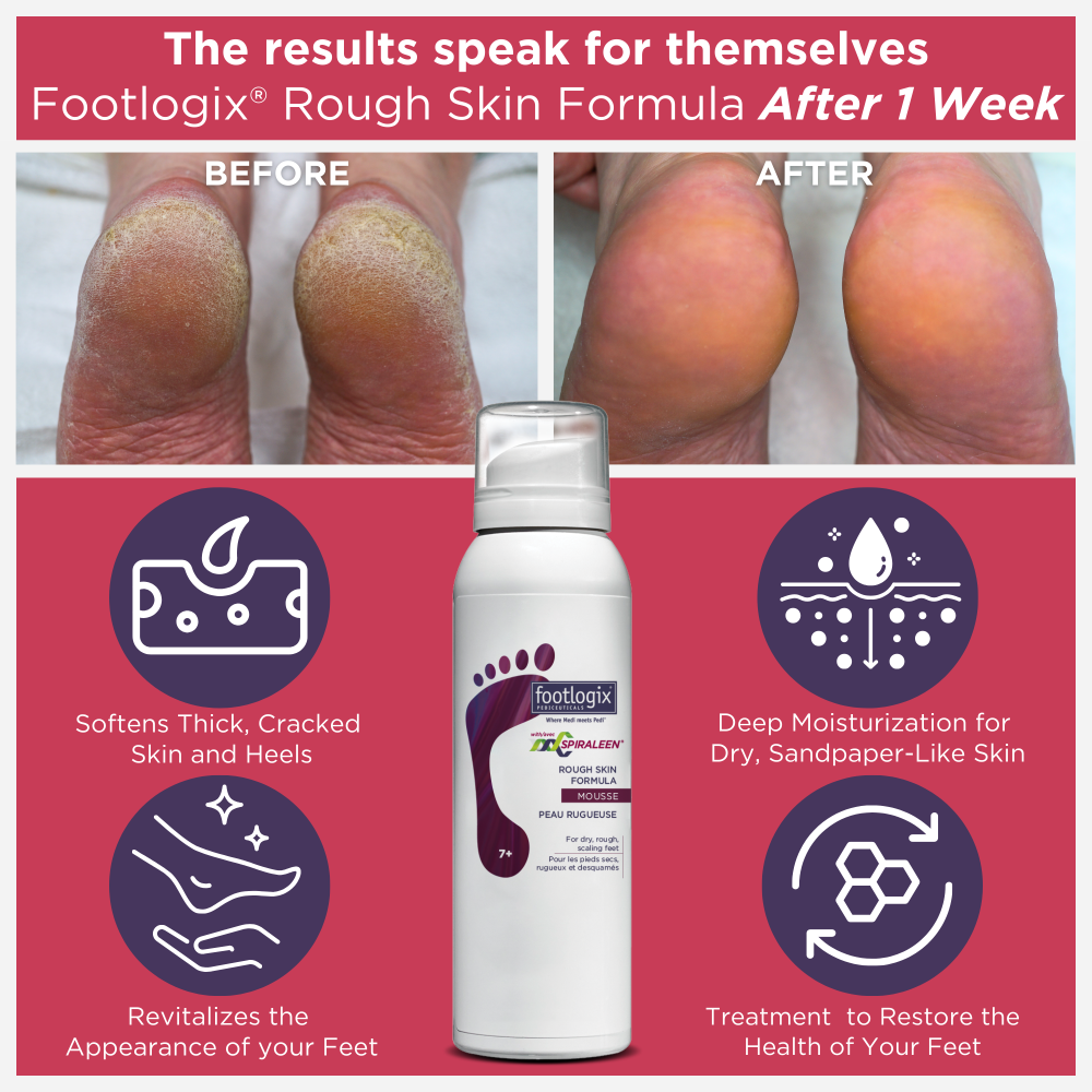 Footlogix Rough Skin Formula