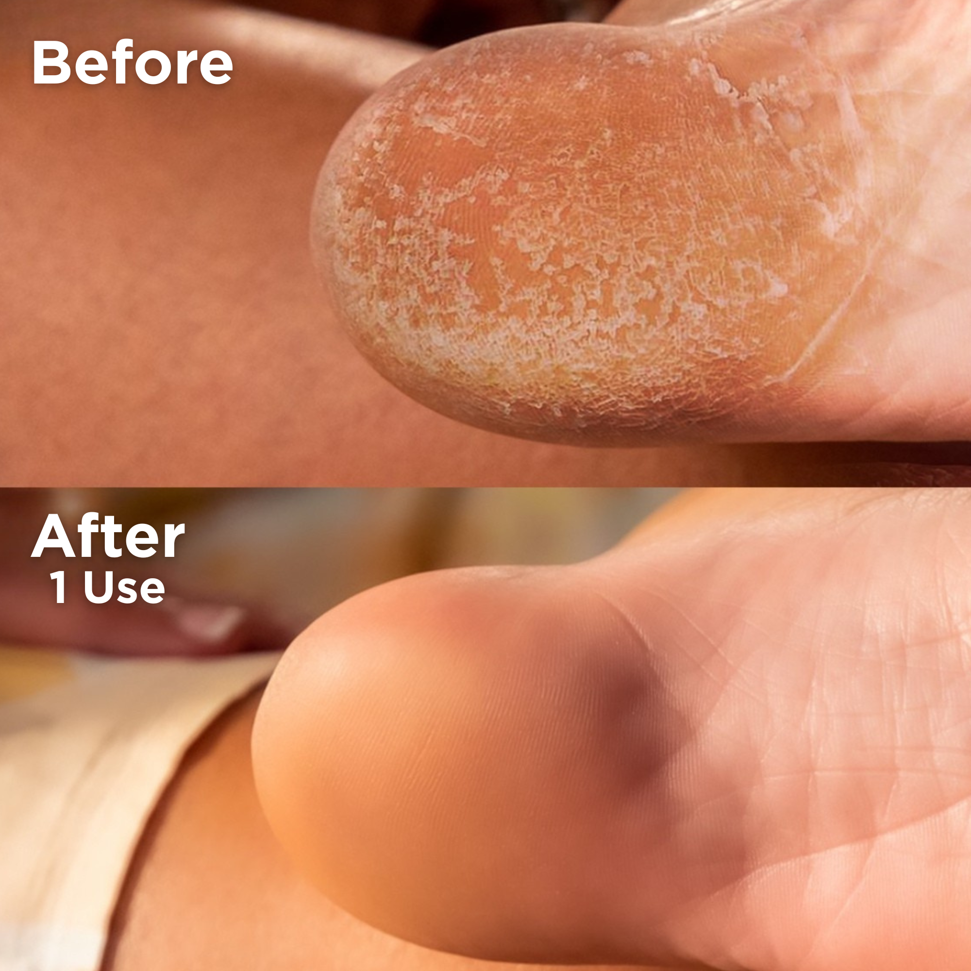 Side-by-side image showing the heel of a foot before and after one use of a foot care product. The top image, labeled 'Before,' shows dry, flaky, and rough skin. The bottom image, labeled 'After 1 Use,' shows a dramatically smoother heel with soft, hydrated, and visibly healthier skin.