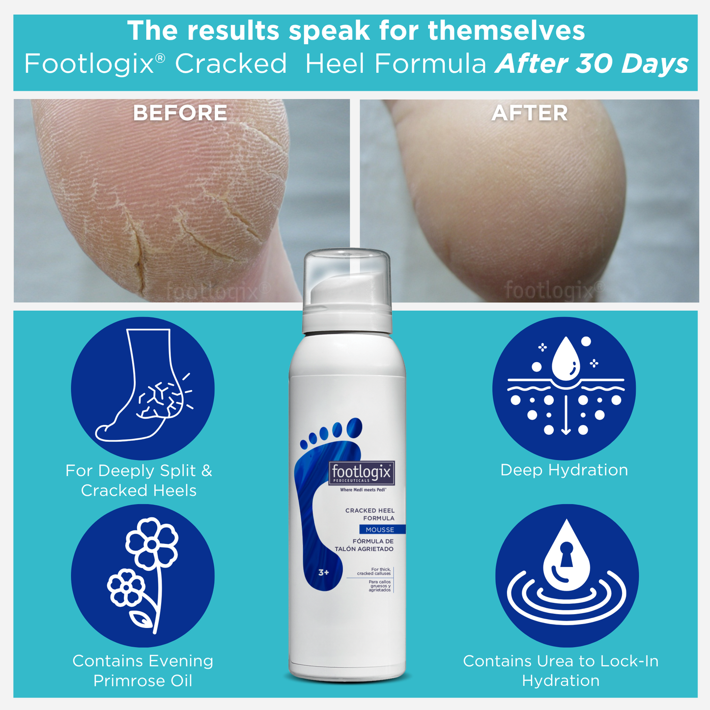 Before and after results of Footlogix Cracked Heel Formula Mousse after 30 days, showing improvement from cracked, dry heels to smooth skin. Product features include deep hydration, Urea to lock in moisture, and Evening Primrose Oil for healing.