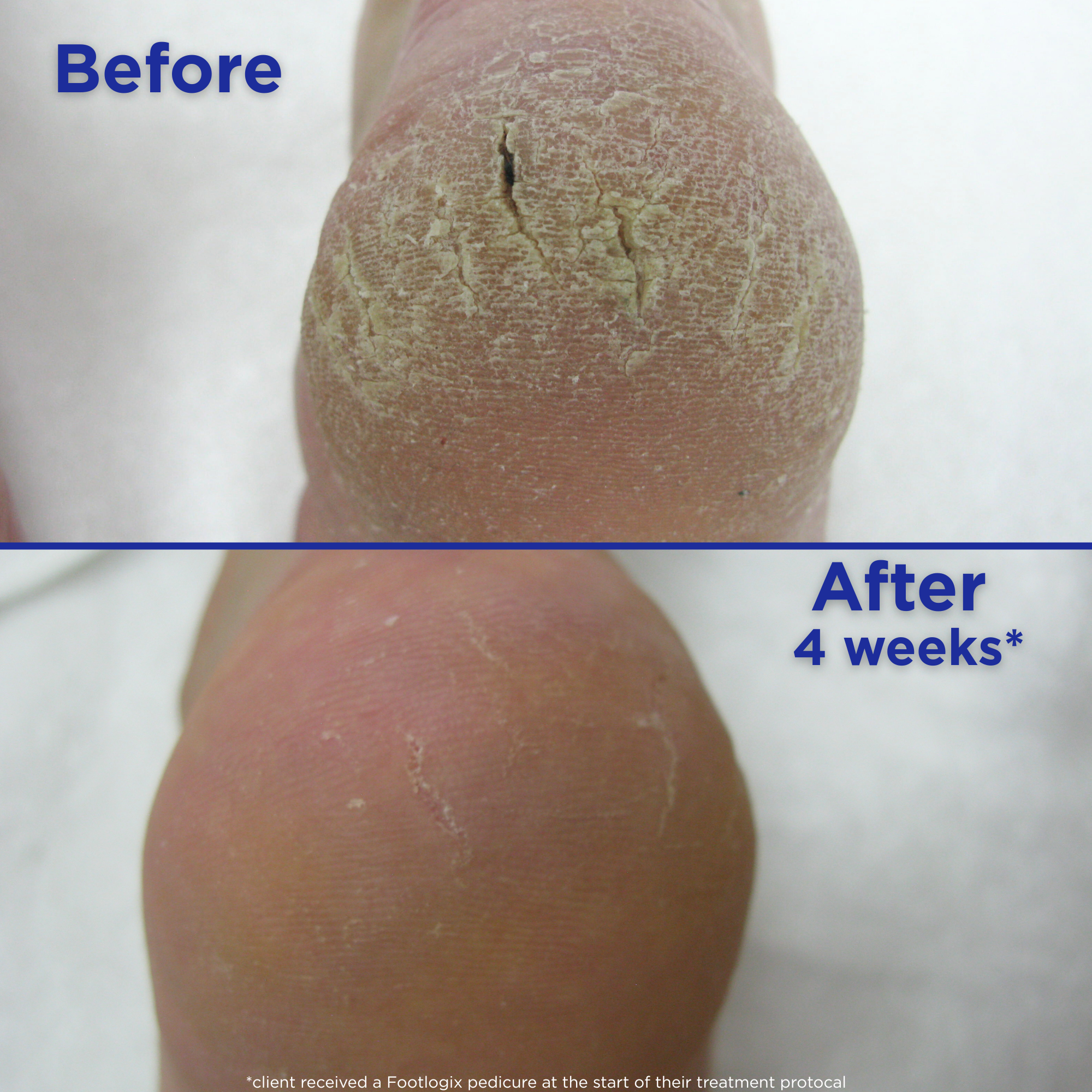 Close-up comparison of a heel before and after using a cracked heel treatment. The top image, labeled 'Before,' shows deep cracks and severe dryness. The bottom image, labeled 'After 4 weeks,' shows the heel looking significantly smoother with reduced cracks and improved skin texture. A note indicates the client received a Footlogix pedicure at the start of their treatment