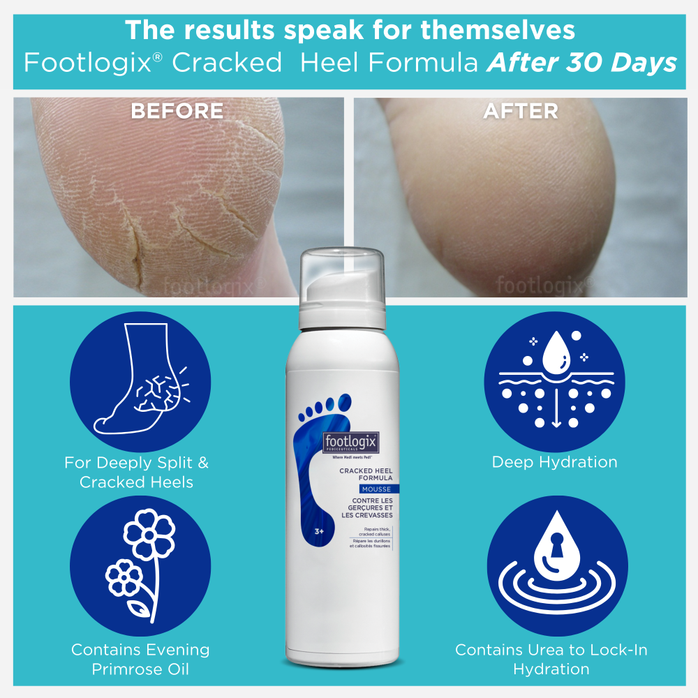 Before and after results of Footlogix Cracked Heel Formula Mousse after 30 days, showing improvement from cracked, dry heels to smooth skin. Product features include deep hydration, Urea to lock in moisture, and Evening Primrose Oil for healing.