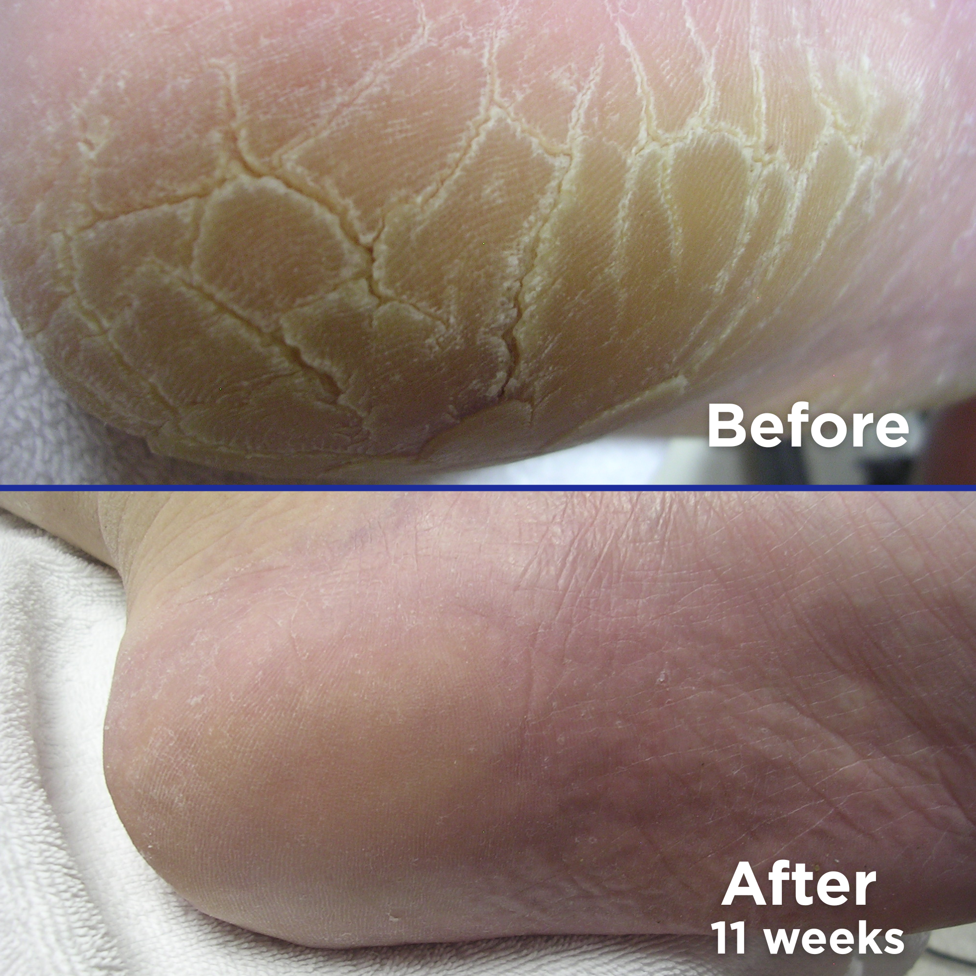 Side-by-side comparison of a heel before and after using a cracked heel treatment. The top image, labeled 'Before,' shows severely dry, thick, and cracked skin. The bottom image, labeled 'After 11 weeks,' shows the same heel looking smoother, softer, and significantly more hydrated with visibly reduced cracks and dryness
