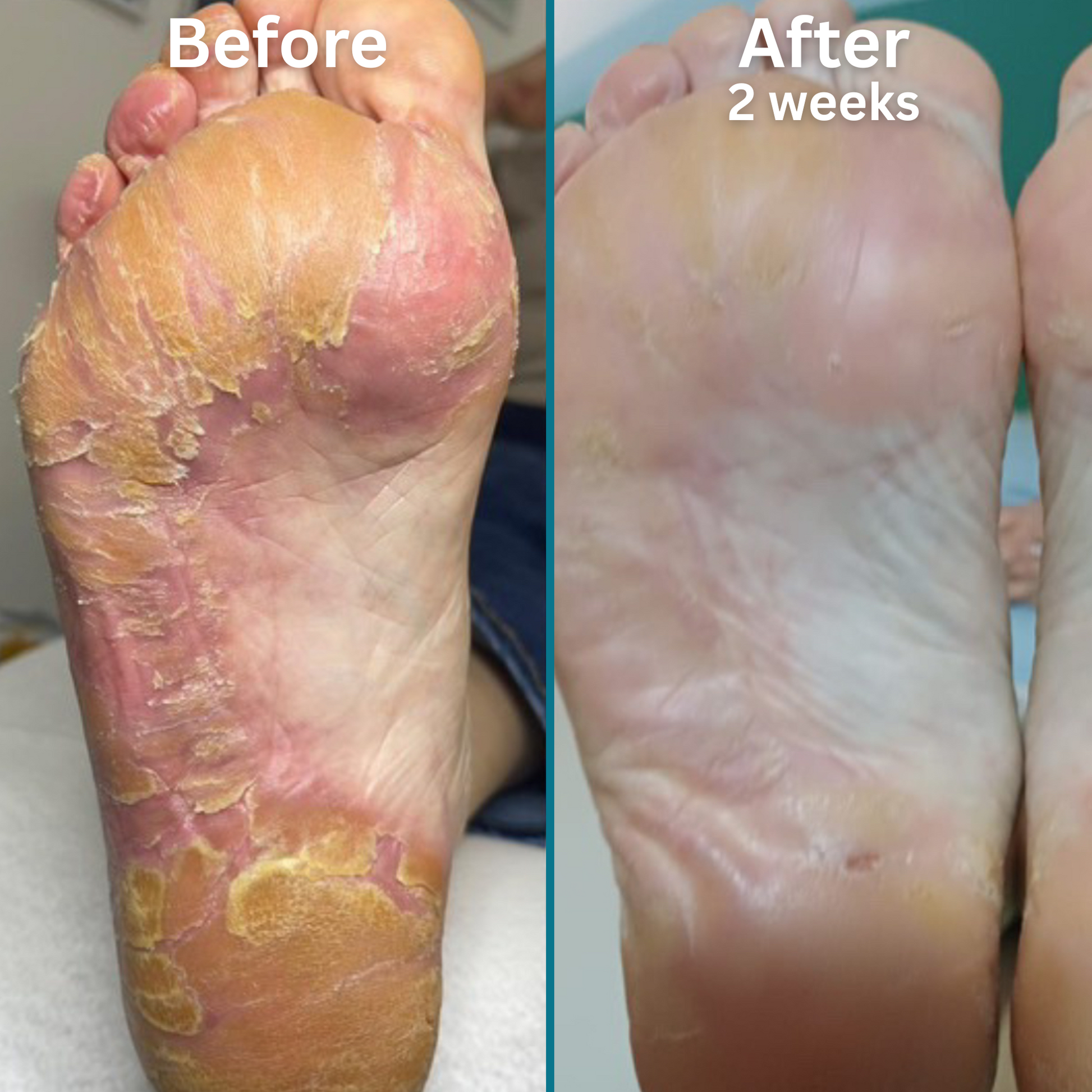 
"Side-by-side image of the sole of a foot before and after using a foot care treatment. The left image, labeled 'Before,' shows severe dryness, redness, and peeling skin across the entire foot. The right image, labeled 'After 2 weeks,' shows significantly improved skin with reduced redness, minimal peeling, and a smoother, more hydrated appearance.