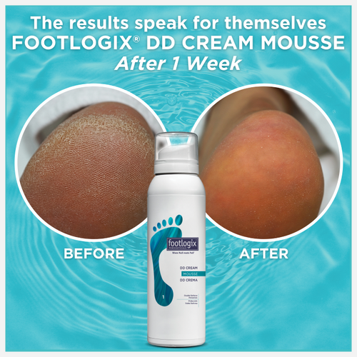 Before and after images of a heel treated with Footlogix DD Cream Mousse, showing significant improvement in skin smoothness and hydration after one week.