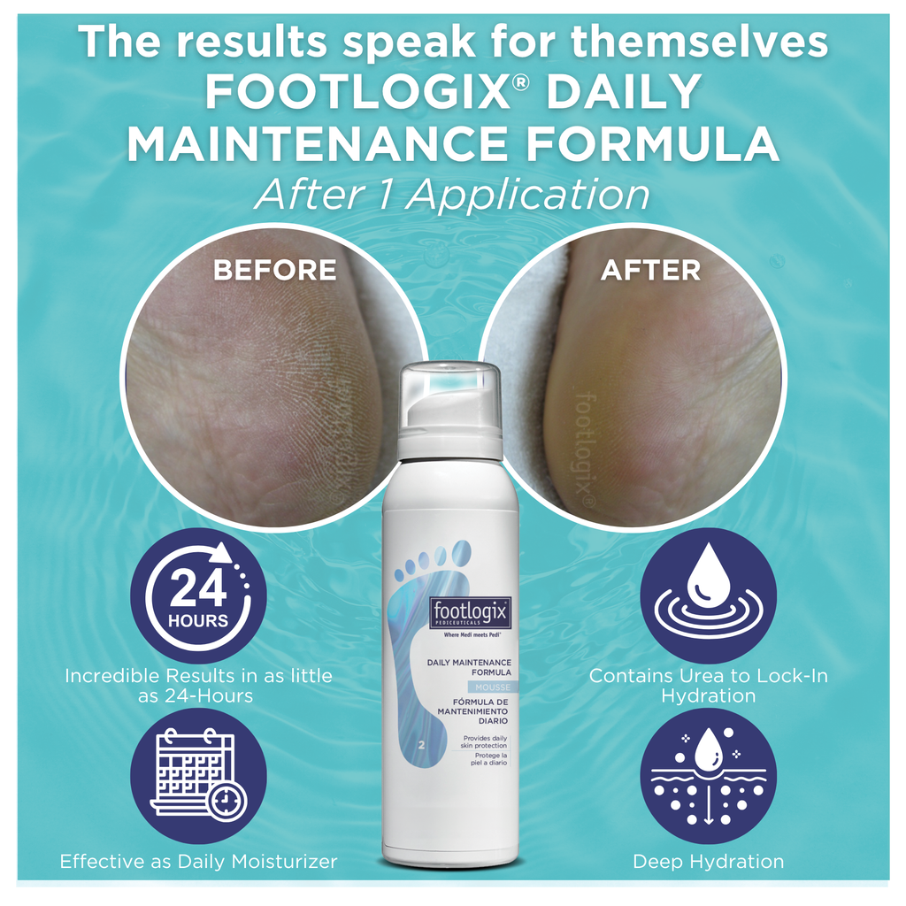 Before and after close-up comparison of a heel showing visibly dry, rough skin on the left and smooth, hydrated skin after one application of Footlogix® Daily Maintenance Formula Mousse on the right. Text highlights 24-hour results, deep hydration, and Urea for moisture lock-in.