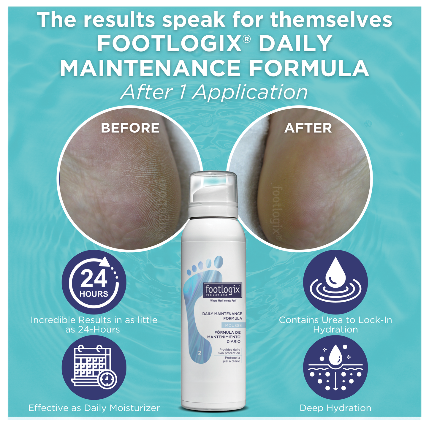 Before and after close-up comparison of a heel showing visibly dry, rough skin on the left and smooth, hydrated skin after one application of Footlogix® Daily Maintenance Formula Mousse on the right. Text highlights 24-hour results, deep hydration, and Urea for moisture lock-in.