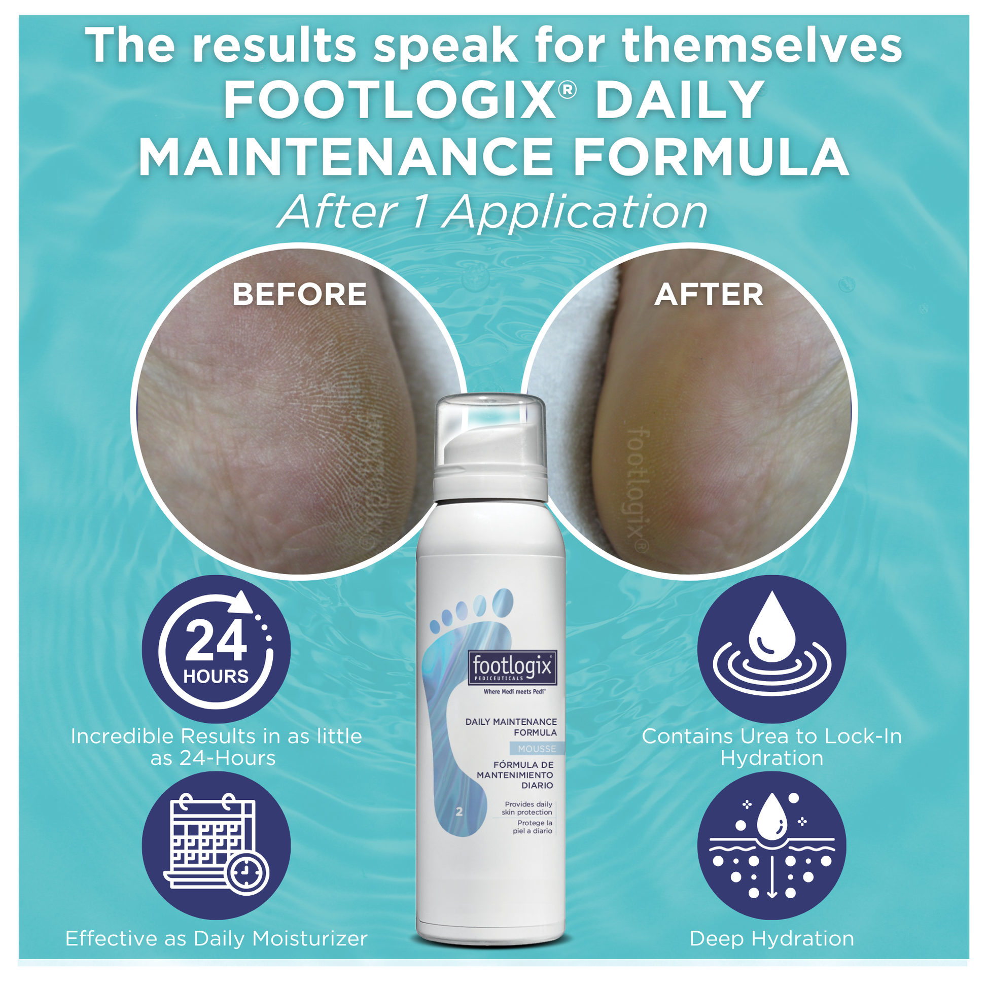Before and after close-up comparison of a heel showing visibly dry, rough skin on the left and smooth, hydrated skin after one application of Footlogix® Daily Maintenance Formula Mousse on the right. Text highlights 24-hour results, deep hydration, and Urea for moisture lock-in.