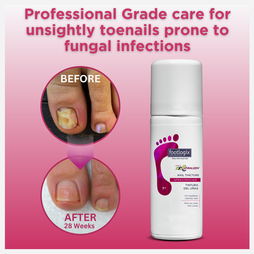 Footlogix Nail Tincture Spray shown next to before-and-after images of toenails affected by fungal issues. Text highlights improvement after 28 weeks using the professional-grade spray.