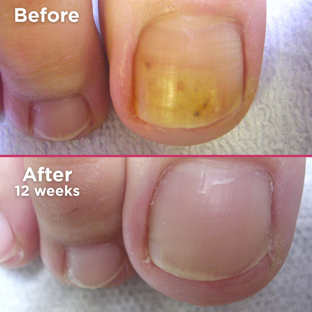 
"Side-by-side image showing a toenail before and after 12 weeks of treatment. The top image, labeled 'Before,' shows a toenail with significant yellow discoloration and dark spots. The bottom image, labeled 'After 12 weeks,' shows the same toenail looking healthier, clearer, and more natural in color with improved nail condition.