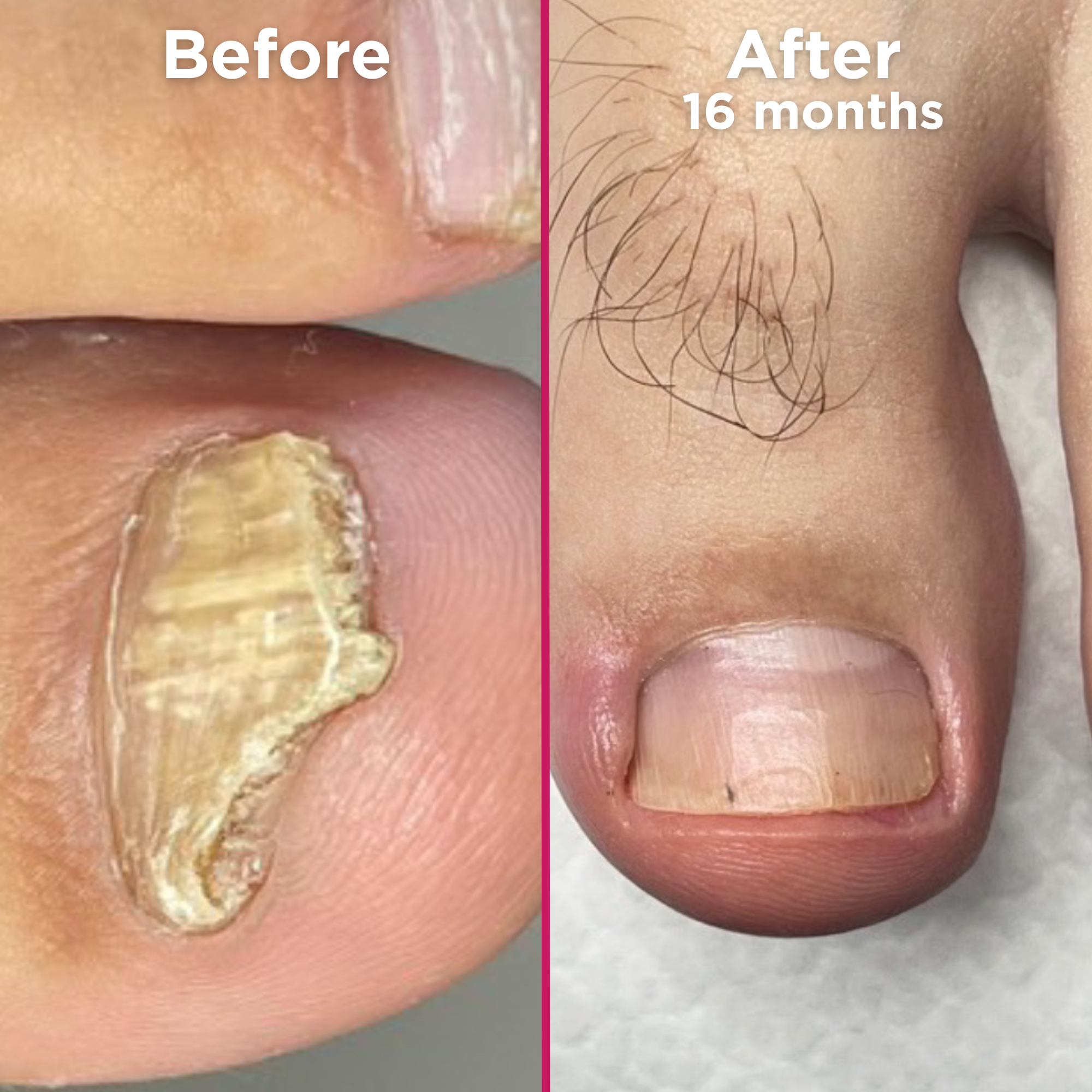 Side-by-side image of a toenail before and after 16 months of nail treatment. The left image, labeled 'Before,' shows a thickened, yellow, and misshapen nail with significant discoloration and fungal damage. The right image, labeled 'After 16 months,' shows a healthy-looking toenail with normal color, smooth texture, and a natural shape, indicating full recovery.