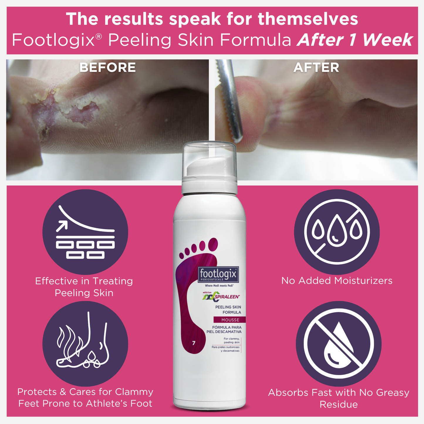 Before and after results of Footlogix Peeling Skin Formula after 1 week, showing improvement in peeling and irritated skin. Highlights include no added moisturizers, fast absorption, and support for feet prone to athlete’s foot.