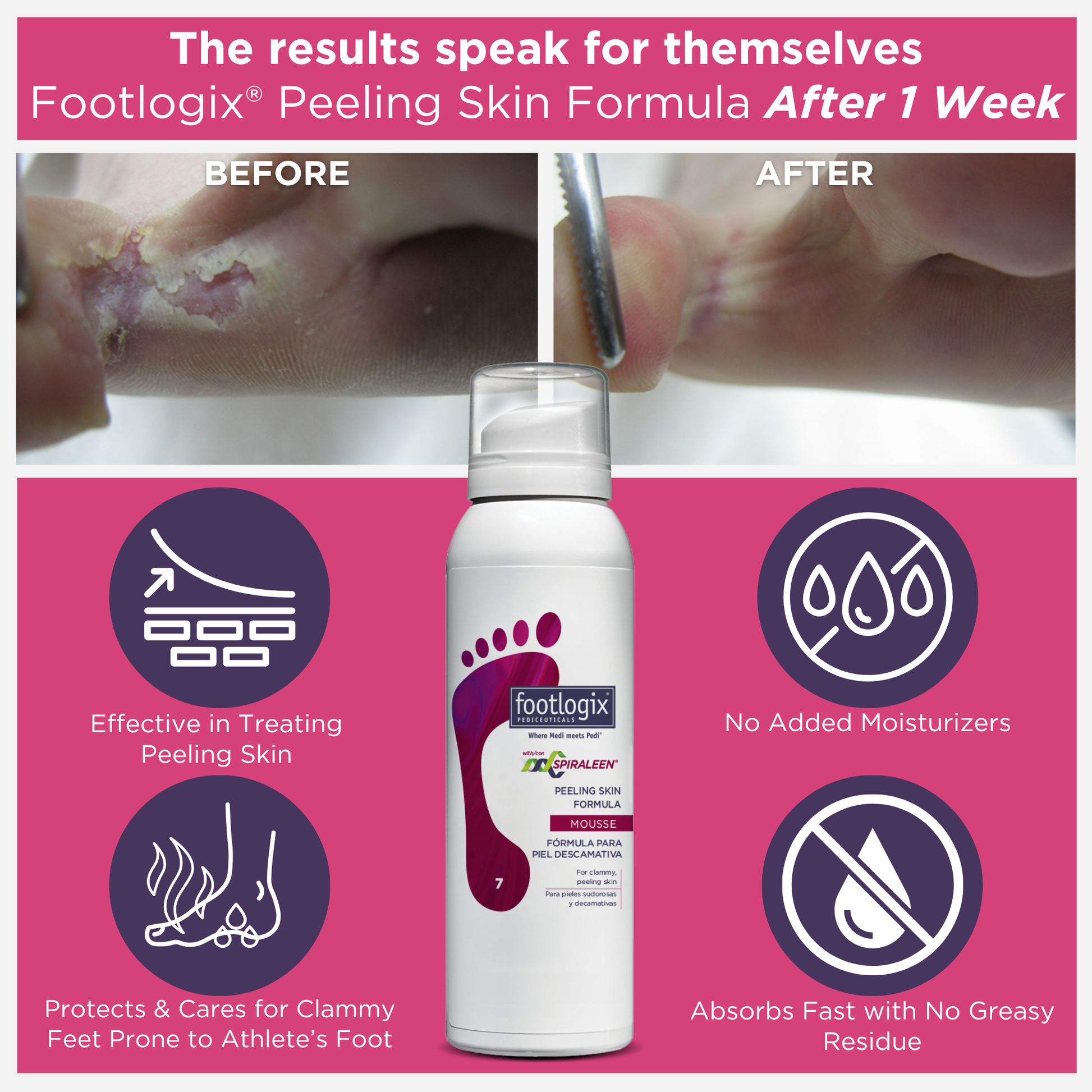 Before and after results of Footlogix Peeling Skin Formula after 1 week, showing improvement in peeling and irritated skin. Highlights include no added moisturizers, fast absorption, and support for feet prone to athlete’s foot.