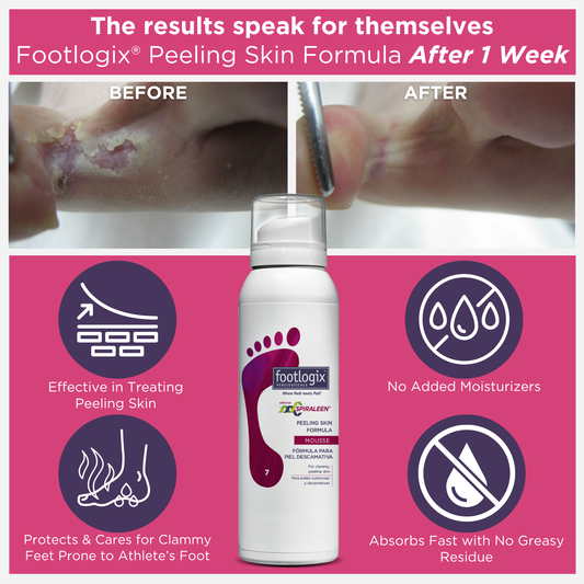 Before and after results of Footlogix Peeling Skin Formula after 1 week, showing improvement in peeling and irritated skin. Highlights include no added moisturizers, fast absorption, and support for feet prone to athlete’s foot.