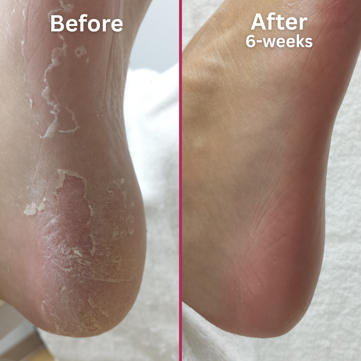 Side-by-side image showing the heel of a foot before and after using a peeling skin treatment. The left image, labeled 'Before,' shows dry, peeling skin with visible flaking. The right image, labeled 'After 6-weeks,' shows the same heel with smooth, healthy-looking skin and no visible peeling.