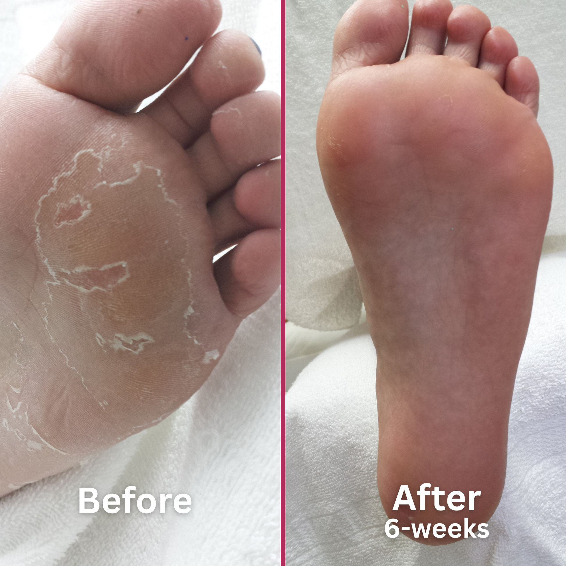 
"Side-by-side image showing the bottom of a foot before and after using a peeling skin treatment. The left image, labeled 'Before,' shows peeling, flaky skin across the sole and toes. The right image, labeled 'After 6-weeks,' shows smooth, healthy skin with a visibly improved texture and no signs of peeling.