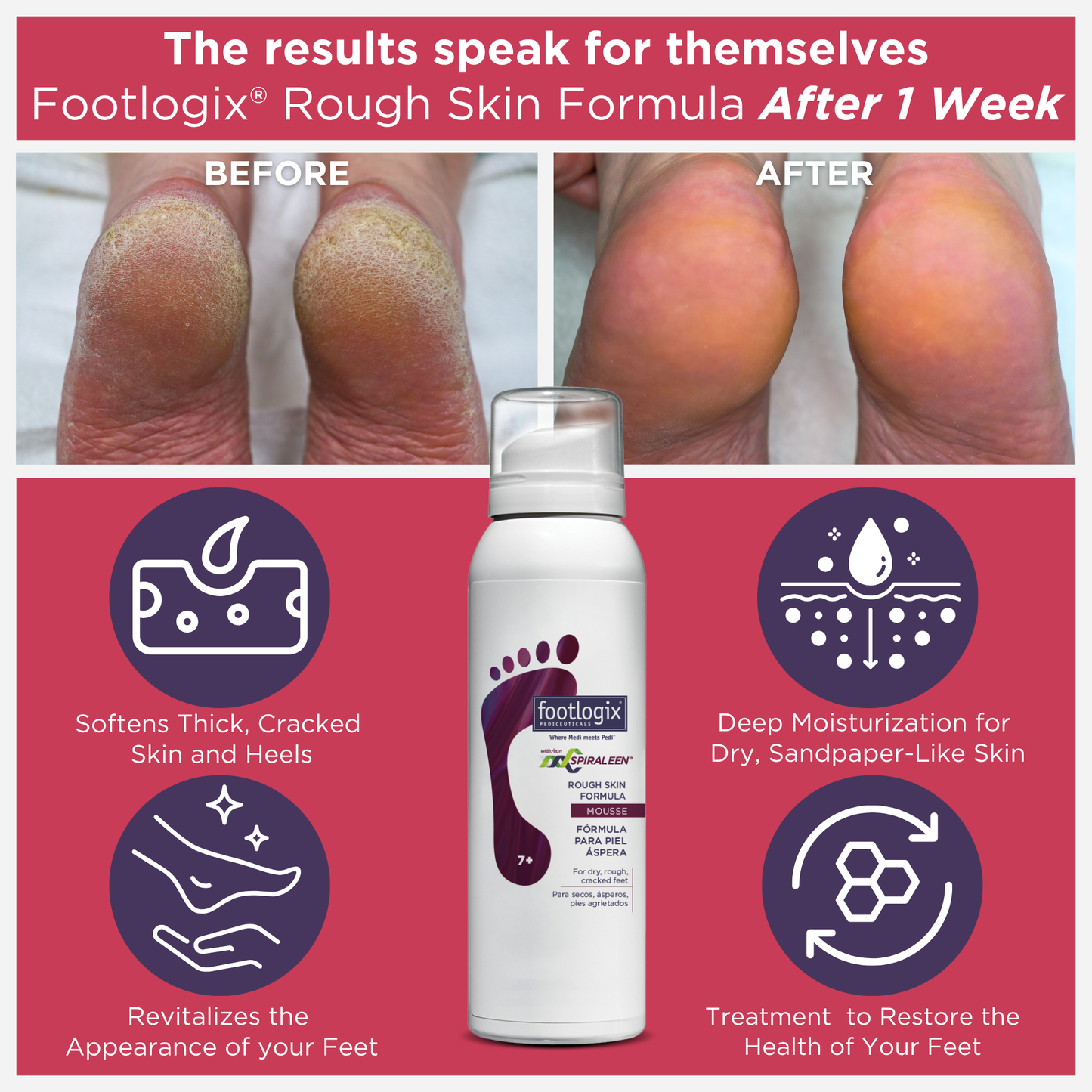 Before and after comparison of feet treated with Footlogix Rough Skin Formula Mousse after 1 week, showing smoother, healthier skin. Highlights include softening thick skin, deep moisturization, and revitalized appearance.