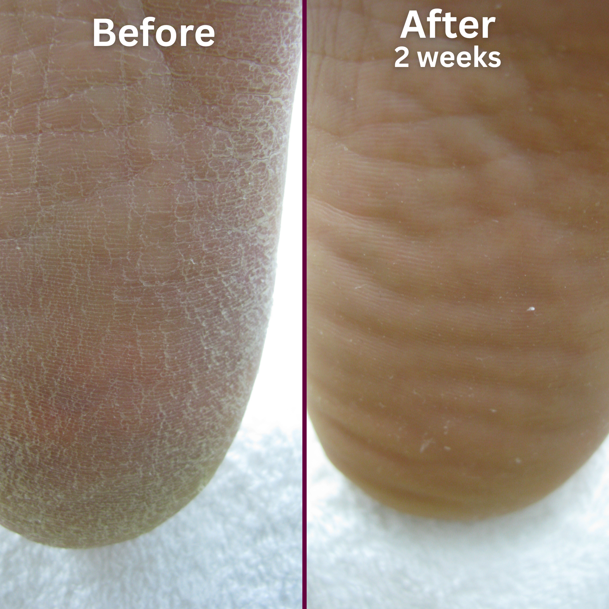Side-by-side image of a foot before and after using a rough skin treatment. The left image, labeled 'Before,' shows dry, cracked, and scaly skin on the heel and sole. The right image, labeled 'After 2 weeks,' shows the same area looking significantly smoother, softer, and more hydrated with visibly improved skin texture.
