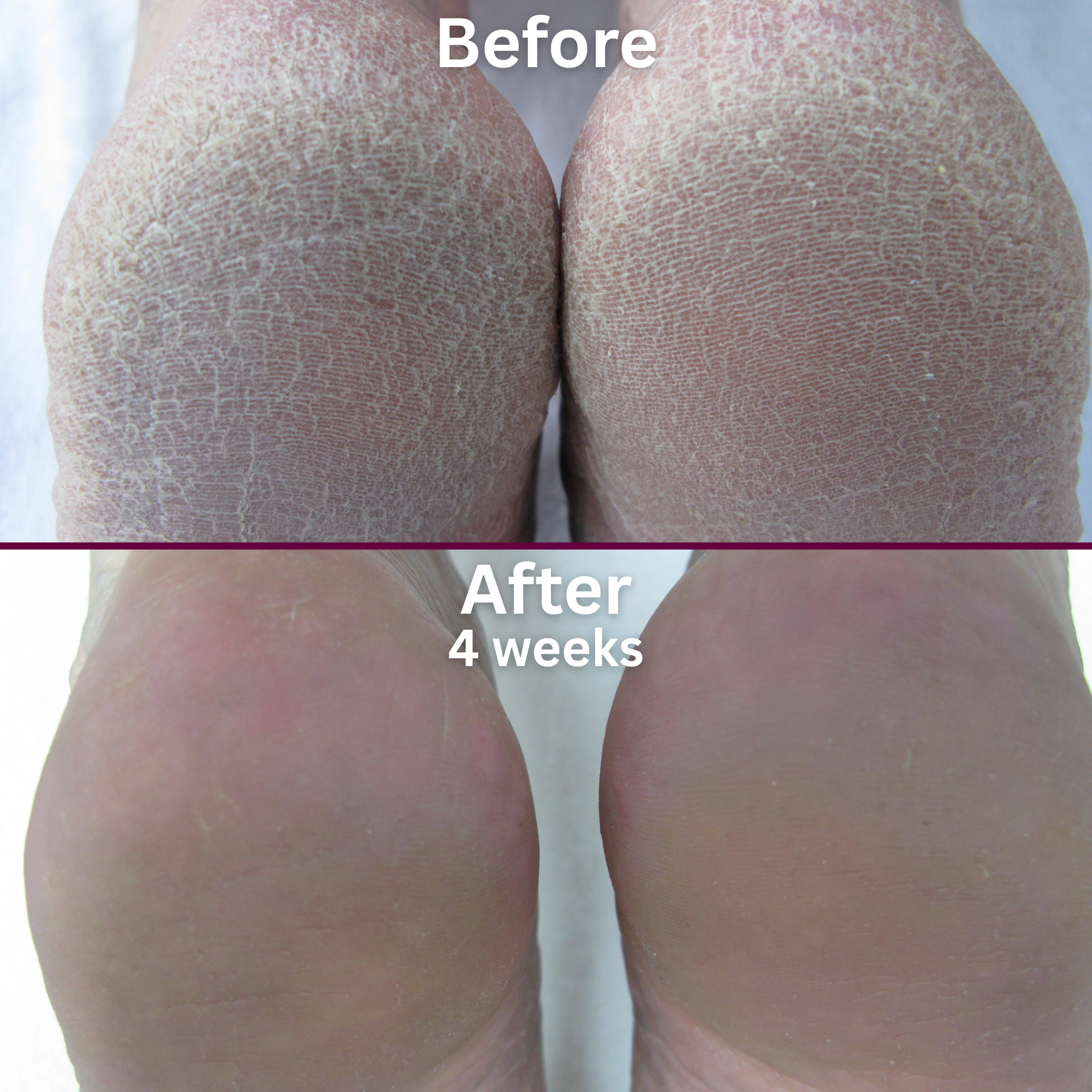 Before-and-after comparison of two heels treated for rough, dry skin. The top image, labeled 'Before,' shows both heels with thick, cracked, and scaly skin. The bottom image, labeled 'After 4 weeks,' shows visibly smoother, softer heels with significantly reduced dryness and improved skin texture.