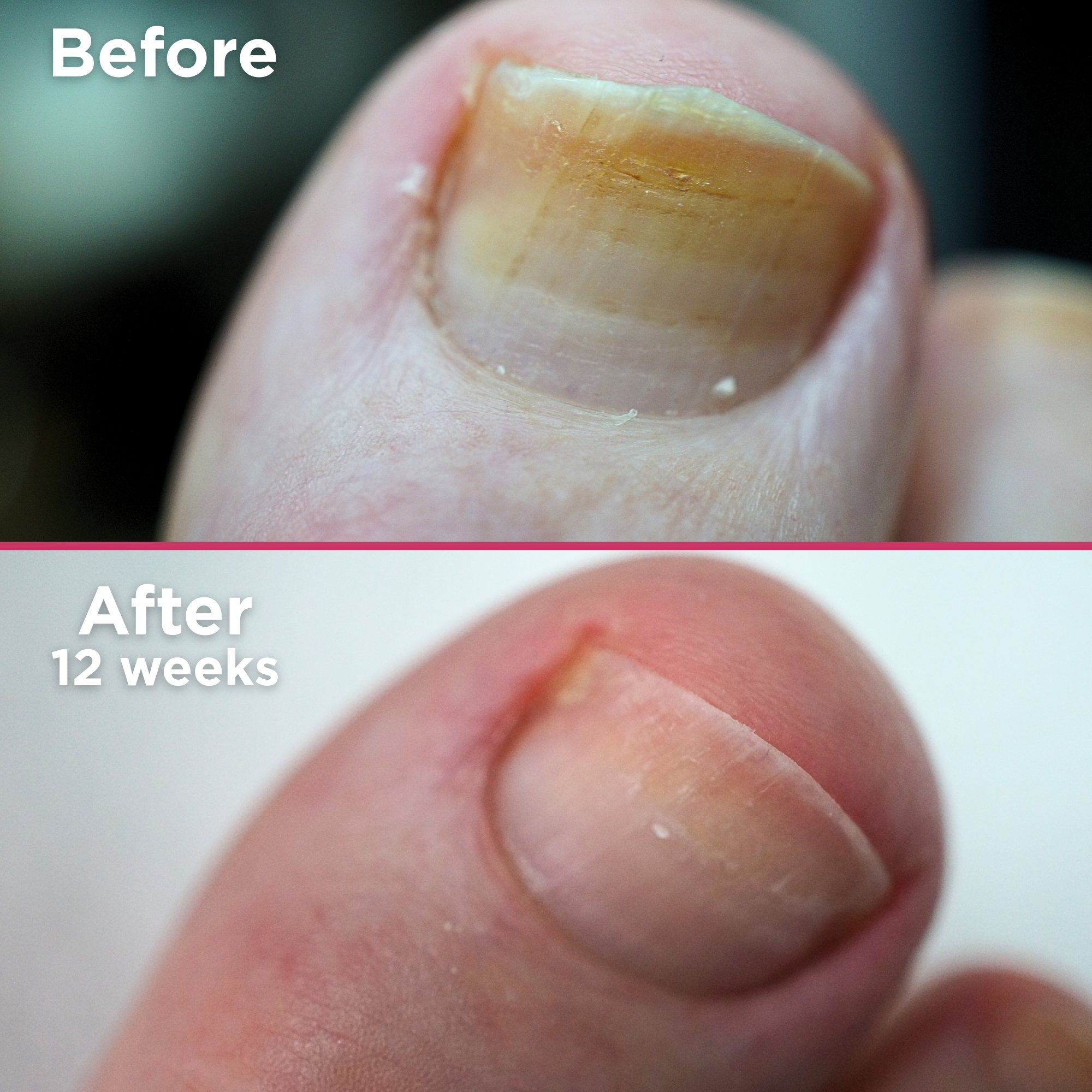 Close-up of a toenail showing visible improvement after using a nail treatment. The top half of the image is labeled 'Before' and shows a thick, yellow, brittle nail with discoloration. The bottom half is labeled 'After 12 weeks' and shows the same toenail appearing healthier, clearer, and smoother with reduced discoloration and improved nail texture.