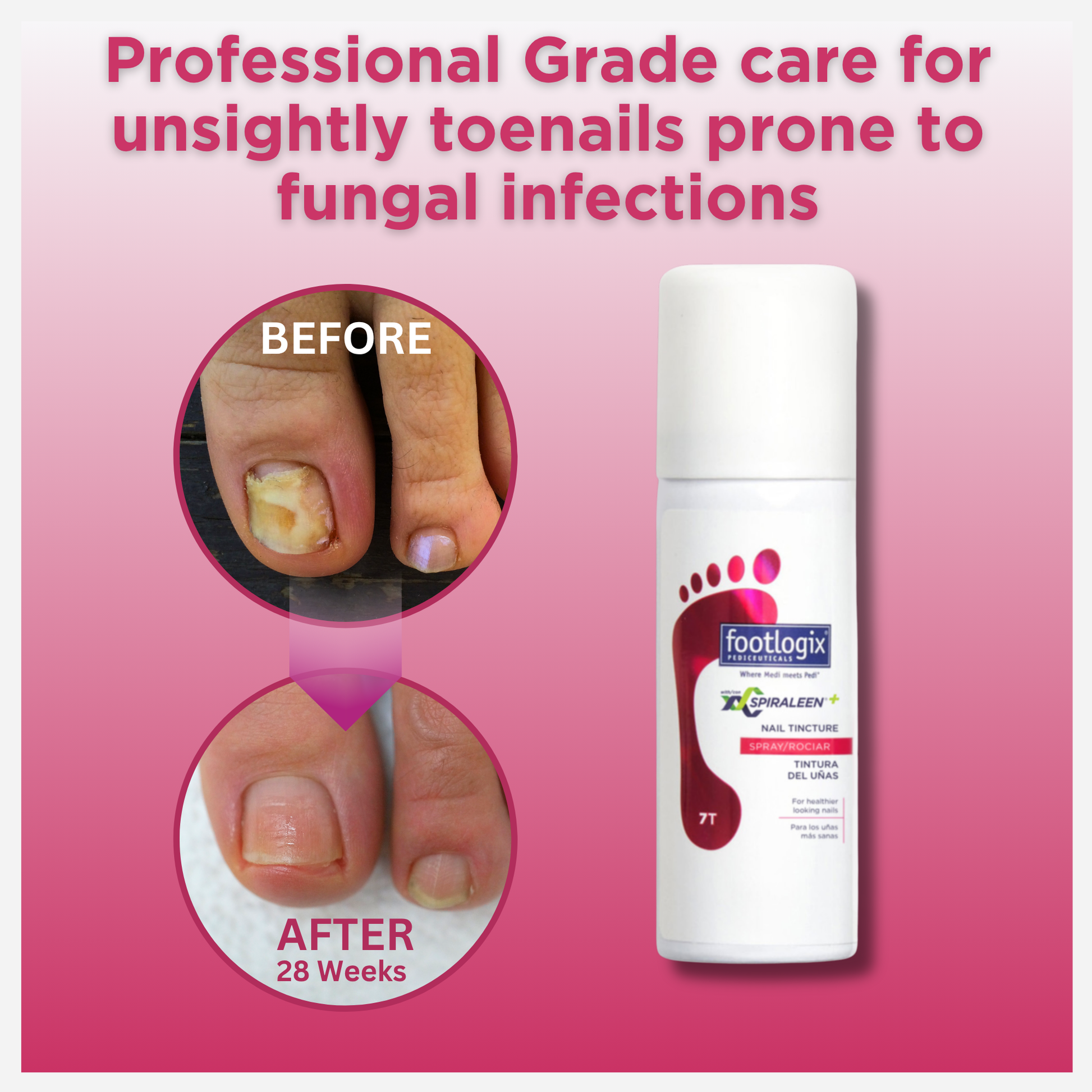 Footlogix Nail Tincture Spray before and after results showing improved appearance of toenails over time