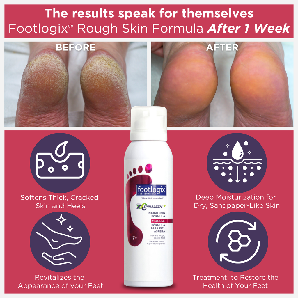 Footlogix Rough Skin Formula before and after showing improved appearance of dry, rough heels over time