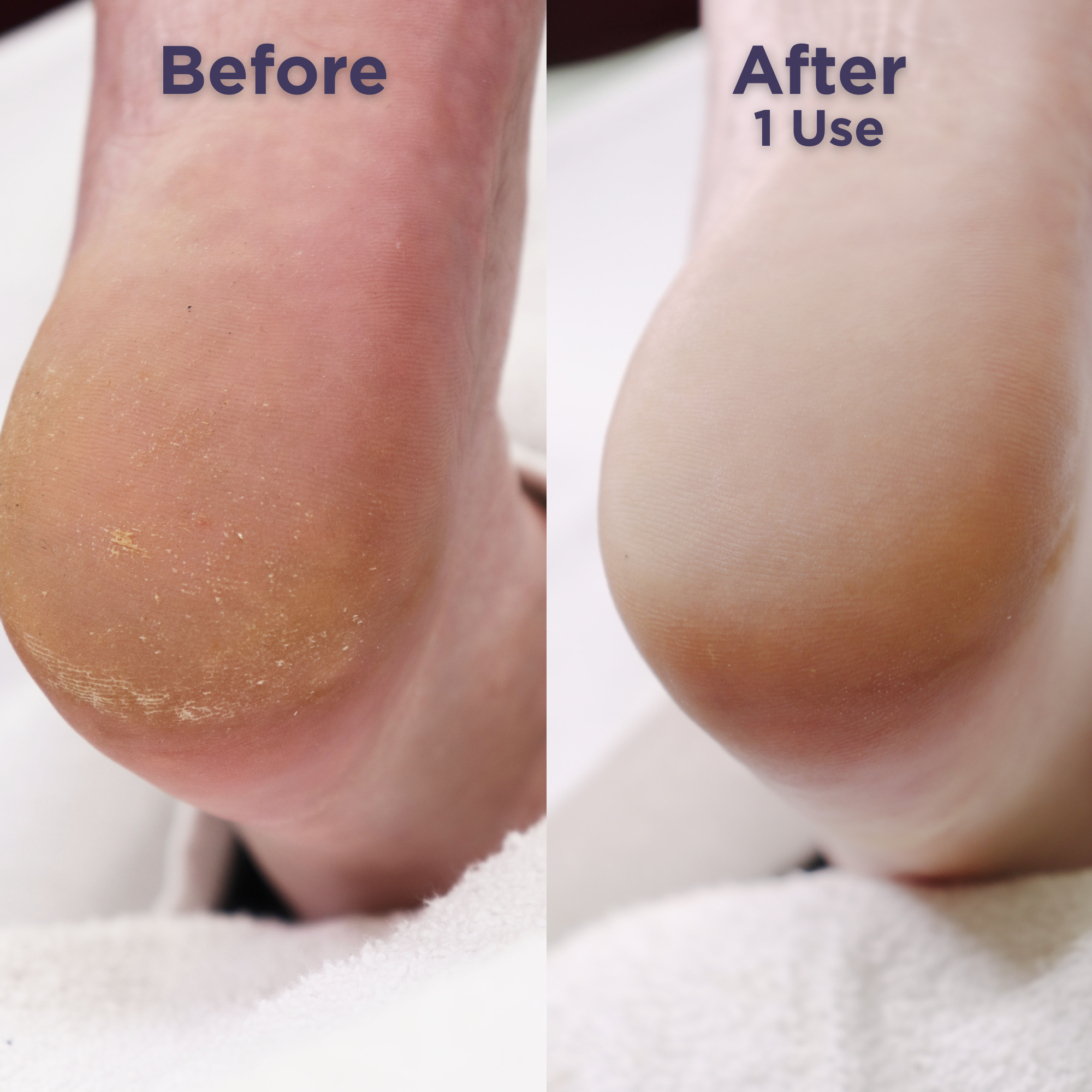 Close-up comparison of a heel before and after using Footlogix Ultimate At Home Combo. The 'Before' side shows dry, callused skin; the 'After 1 Use' side reveals visibly smoother, hydrated, and healthier-looking skin.