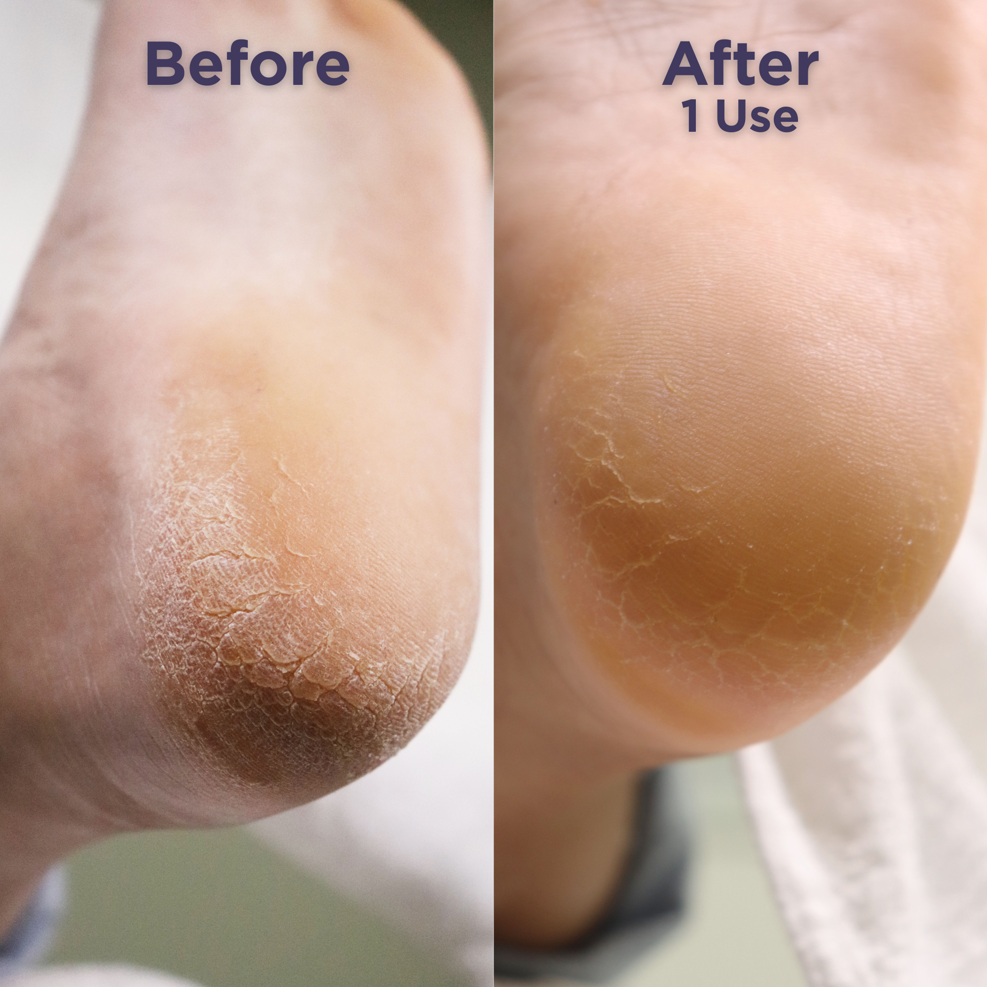 Close-up comparison of a heel before and after using Footlogix Ultimate At Home Combo. The 'Before' side shows dry, callused skin; the 'After 1 Use' side reveals visibly smoother, hydrated, and healthier-looking skin.
