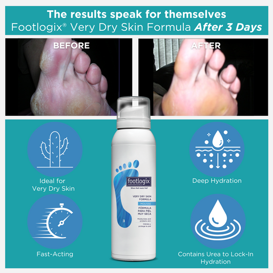 Side-by-side comparison showing dry, rough feet labeled “Before,” and visibly smoother, hydrated feet labeled “After 3 Days.” Below, the Footlogix® Very Dry Skin Formula can is shown with icons for deep hydration, fast-acting formula, and Urea content.
